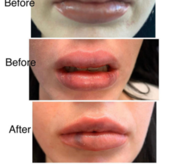 Before and After results of a woman by Lip Enhancement treatment | Center for Aesthetic Medicine in Las Vegas, NV