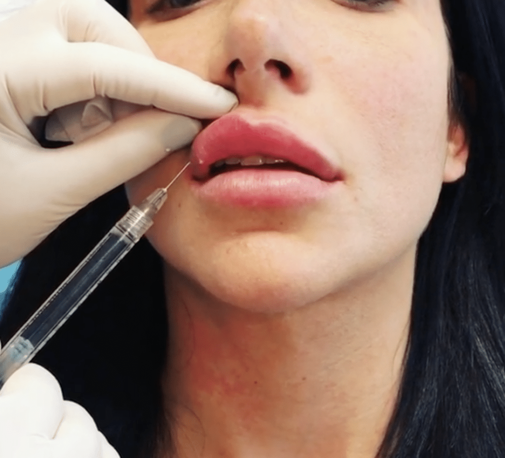 Dermal filler image of women getting lip injections