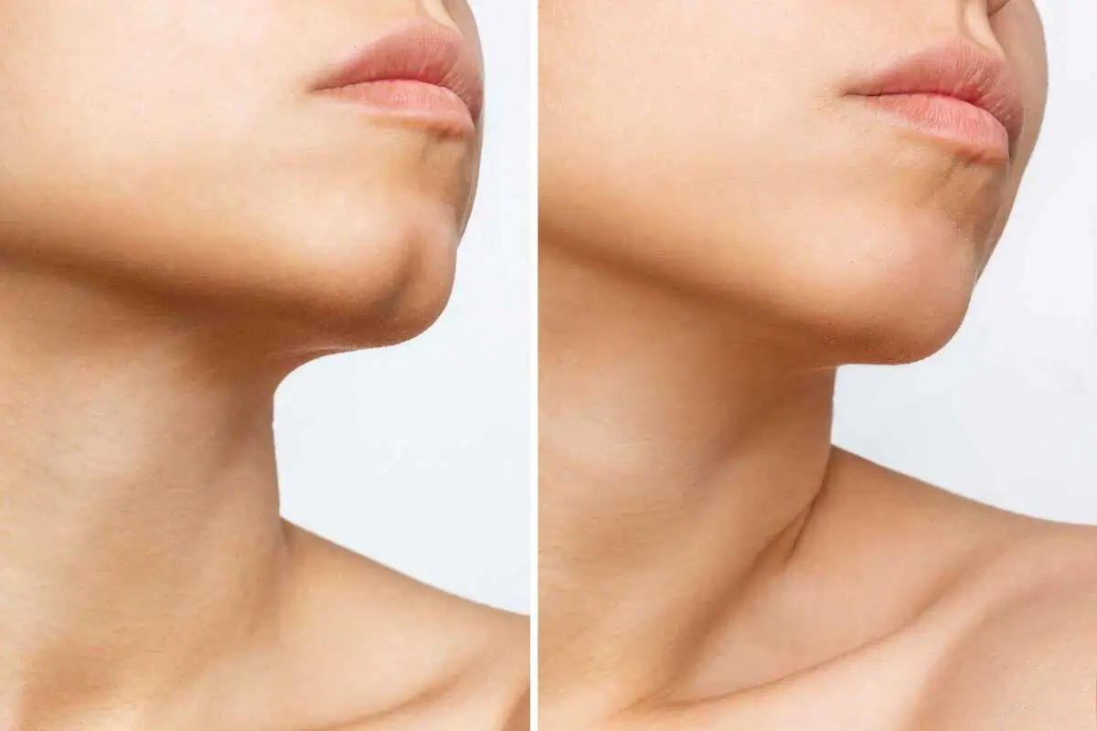 Chin-Dimpling-Center-for-Aesthetic-Medicine