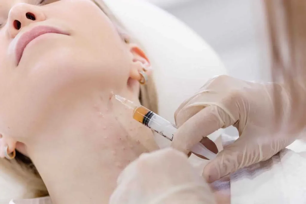 Microneedling With PRP at Center for Aesthetic Medicine